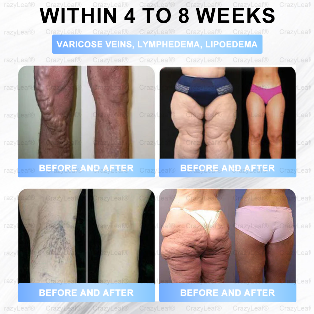 FDA Store |𝐵uil𝗱𝐿ea𝐟® 𝑮𝐋𝑃-1 Slim & Firm 𝑁ano 𝑀icroneedle 𝑃atch with Collagen,Turmeric&Matrixyl 3000 丨Obesity,Cardiovascular Diseas, Diabetes, Sleep Apnea, Joint Problems and More